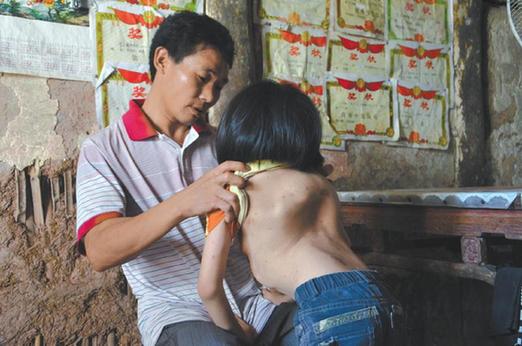 有嚴(yán)重脊椎畸形及胸腔隆突病的李文霞。
