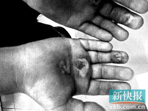 廣州一男孩被學長用煙頭燙爛手掌 踢傷下體(圖)