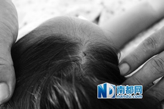 女童頭上被扎的針孔（圓圈處）。賈先生說，被扎不到三秒鐘，女兒就昏了。
